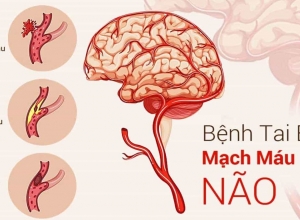 Nguyên nhân gây tai biến mạch máu não và cách phòng tránh
